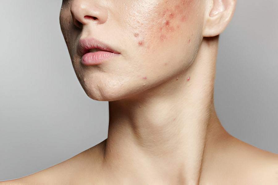 Red Light Therapy for Acne